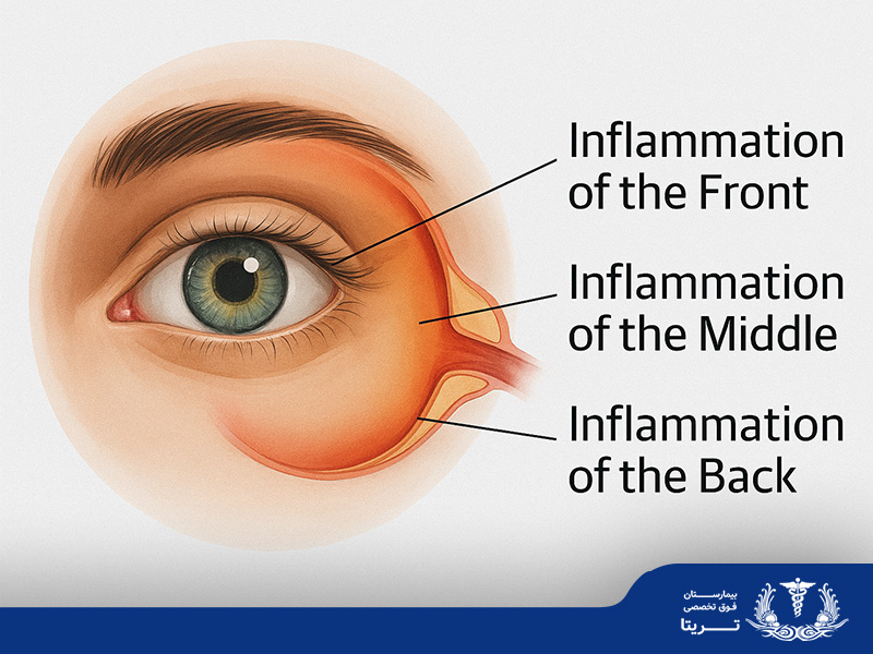 یووئیت چشم: علائم، علتها و کاملترین راهنمای درمان یووئیت چشم