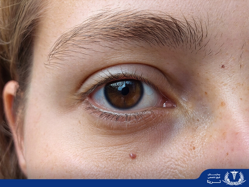 شالازیون چشمی چیست؟