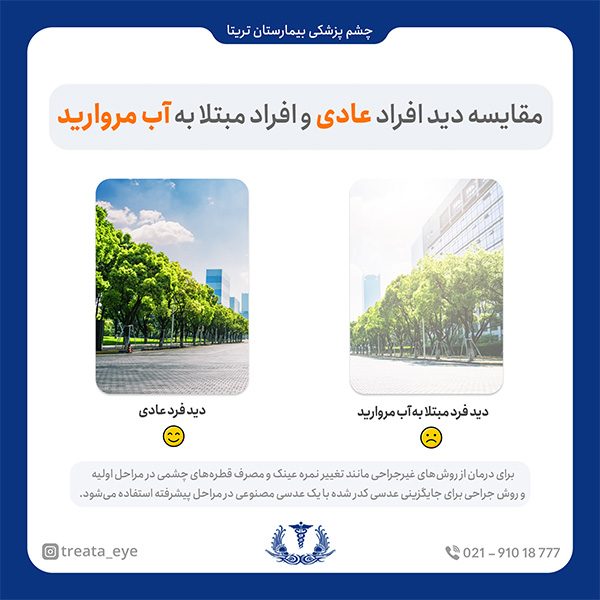 normal-sight-and-cataract-sight-comparison تاری دید بعد از عمل آب مروارید چقدر طول میکشد؟